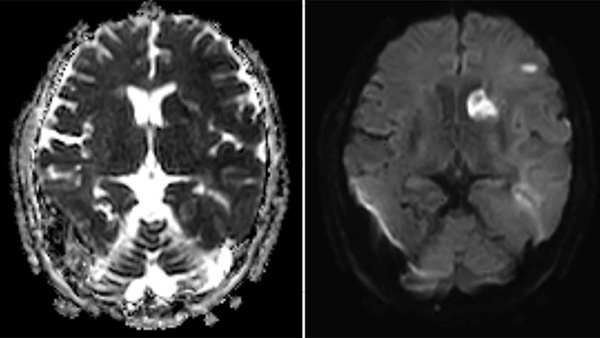 Complex dural arteriovenous fistula - an unusual cause of ischemic stroke: Xper-CT helps open the closed door