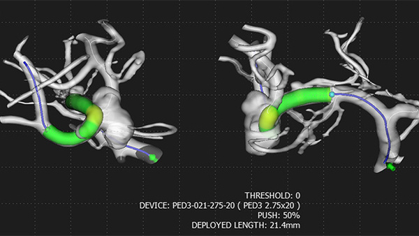 Complex right middle cerebral media artery (MCA) aneurysm treatment with Pipeline™ Vantage with Shield Technologytm and RIST™ radial system