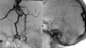 Complex Symptomatic Borden Type III dAVF Initially Misdiagnosed as 2 Shunting Lesions