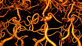 Complex Vertebro-Basilar Junction Aneursym