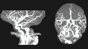 Congenital artero venous fistula in a pediatric patient: It is worth to keep the collaterals open?