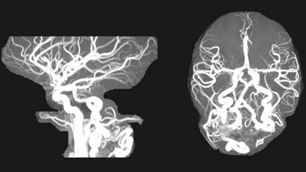 Congenital artero venous fistula in a pediatric patient: It is worth to keep the collaterals open?