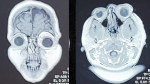 Cookie cutter technique for percutaneous direct puncture glue embolization of orbital hemangioma in a pediatric patient with NF1