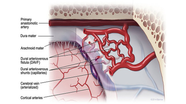 Cranial dural AVF
