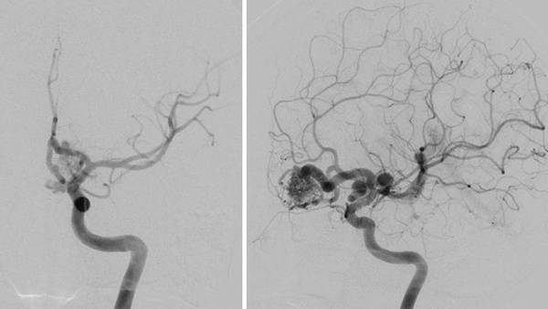 Curative Embolization of Cerebral AVMs - Glue is Still Relevant: Case illustrations