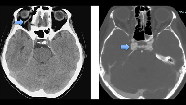 Dural arteriovenous fistula mimicking CCF