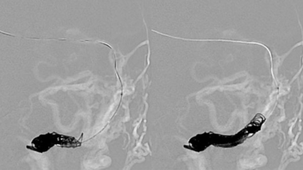 Delayed Cerebral Venous Thrombosis following Dural Fistula Embolization
