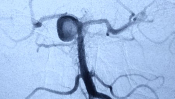 A different endovascular technique in multiple brain aneurysms