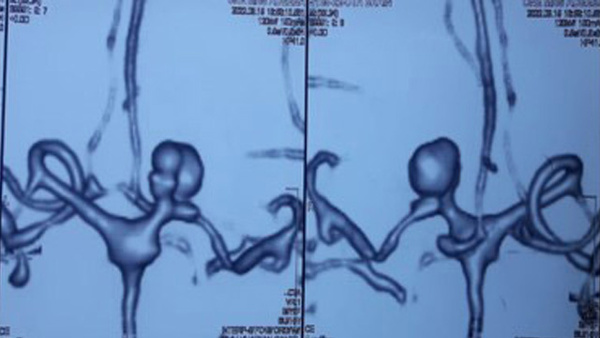 Dissecting Aneurysm with Moya Moya