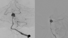 Dissecting basilar aneurysm-Flow diversion with coil placement