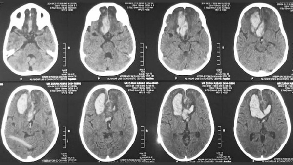 Double edged sword: Balloon Assisted Coiling in dumb bell shaped AComA Aneurysm in 7 years child