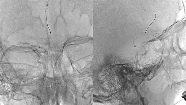 Double MeVO treated with Solitaire™ 3 mm