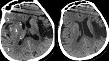 Double stent retriever mechanical thrombectomy of refractory right MCA bifurcation thrombus in a patient who previously had left MCA infarct