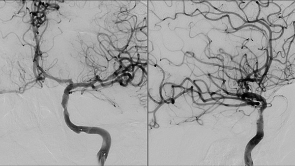 Double stenting technique thrombectomy and PTA treatment for intracranial stenosis
