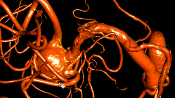 Double Y Stenting for stent assisted coil embolisation using 3 pEGASUS HPC