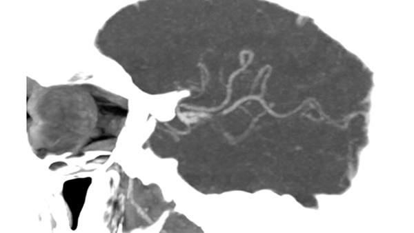Elective thrombectomy with combined technique in M2 occlusion