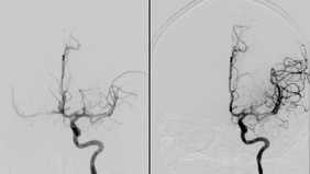 Embolic occlusions in all three cerebral circulations: excellent clinical outcome after four vessel thrombectomy