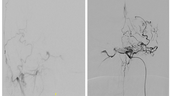 Embolization of bilateral indirect CCF