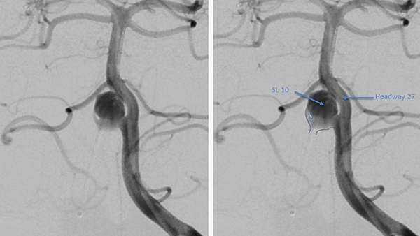 Embolization of VBJ fenestration aneurysm