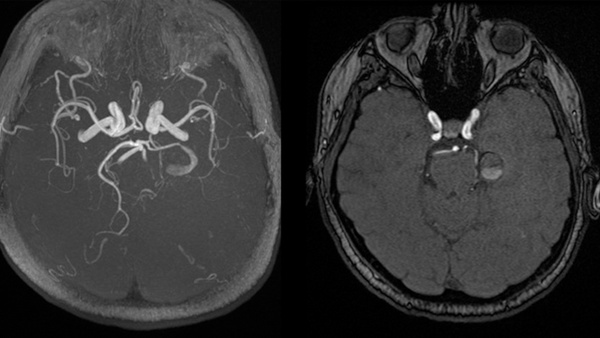 Endovascular coil occlusion of a giant serpentine aneurysm