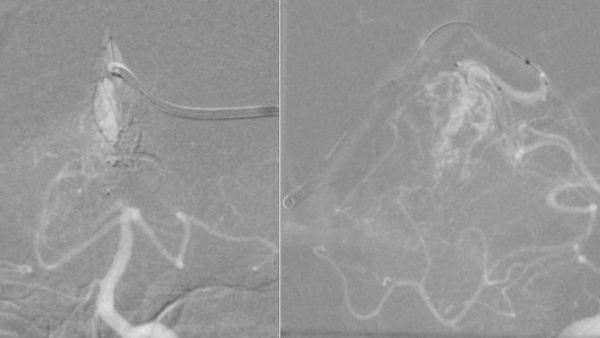 Endovascular Embolisation of a Ruptured Vermian Pial Arteriovenous Malformation