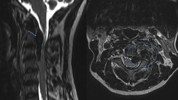 Endovascular Embolization of Spontaneous Vertebro-Vertebral Arteriovenous Fistula with liquid embolics in a case of Neurofibromatosis Type I