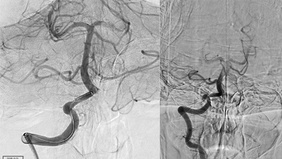 Endovascular Management of Recurrent Large Vessel Occlusion from Vertebral Artery Dissection Refractory to Medical Treatment
