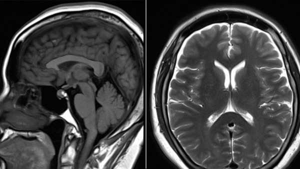 Endovascular Therapy for Intracranial Hypotension secondary to Spinal CSF-Venous Fistula