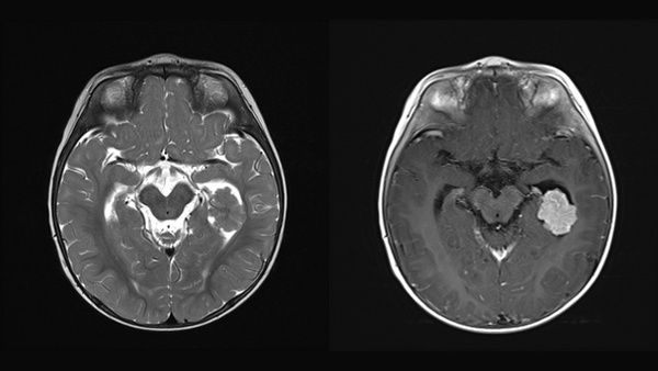 Endovascular treatment of a Choroid Plexus Tumor