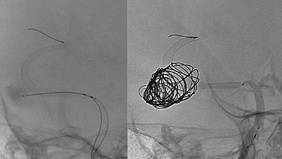 Endovascular treatment of a giant dissecting aneurysm of PCA in a child using a flow-diverter stent