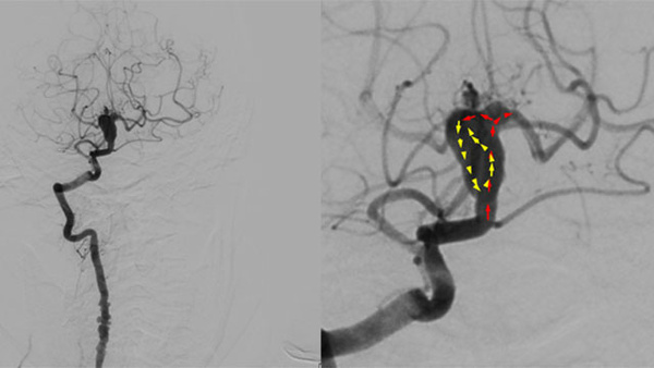 Endovascular Treatment of a Ruptured Dissecting Basilar Apex Aneurysm in a Patient with Multiple Intracranial Aneurysms