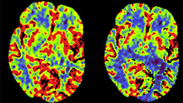 Endovascular Treatment of Isolated Transverse Sinus Dural-AV Fistula
