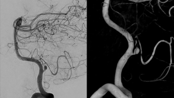 Endovascular Treatment of Unruptured Dissecting PICA Aneurysm Presenting With Ischemic Stroke