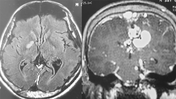 Endovascular treatment of a pial AVM with large venous pouch in a Covid-19 patient