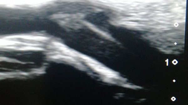 Endovascular treatment of the post-traumatic superficial temporal artery - High flow fistula of the superficial temporal vein
