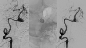FDS Intussusception