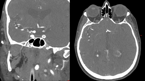 First-Pass Complete Reperfusion in a Left Carotid-T Occlusion Using an Aspiration Catheter and XL Delivery Catheter