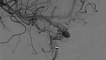 First US treatment of 3 patients with the FRED device after FDA approval