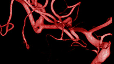 First use of LVIS Evo stent in England