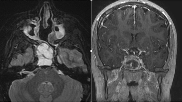 From Chaos to Control: Repairing Iatrogenic ICA Injury in Endoscopic Endonasal Surgery