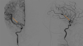 From Invisible to Curable Endovascular Cure of a Heubner’s Micro-AVM in a Child