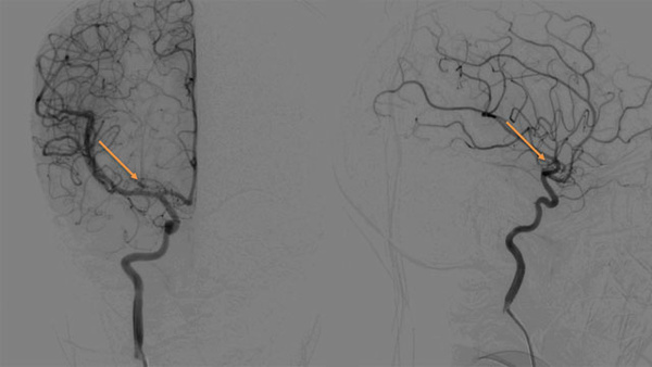 From Invisible to Curable Endovascular Cure of a Heubner’s Micro-AVM in a Child