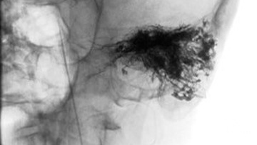 A left tympanic glomus