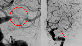 Hyperacute Hyperperfusion in ICAD stenting