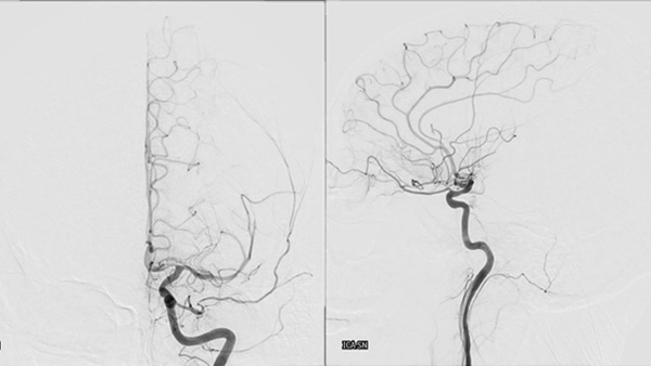 ICA-M1 intracranial dissection EVT