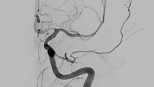 ICA-M1 intracranial dissection EVT