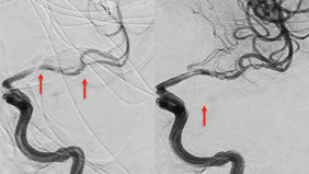 ICA occlusion