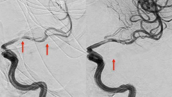 ICA occlusion
