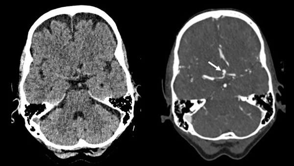 Implantation of an Artisse™ intrasaccular Device for an incidental Acom aneurysm