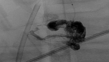 Ischemic stroke and cerebral vasospasm in a COVID-19 patient